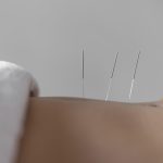 Acupunctuur en ivf: werkt acupunctuur echt als fertiliteitsbehandeling?